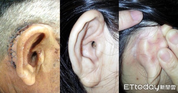 ▲▼  耳內視鏡微創手術 -耳膜修補無負擔           。（圖／記者翁伊森翻攝）