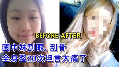 國中妹「一年整形20次」輟學當網美！割眼皮肉、刮骨墊下巴　坦言太痛不整了