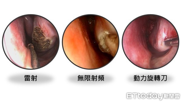 ▲▼  鼻塞治療利器，『動力旋轉刀』微創手術，重獲暢快呼吸!           。（圖／記者翁伊森翻攝）