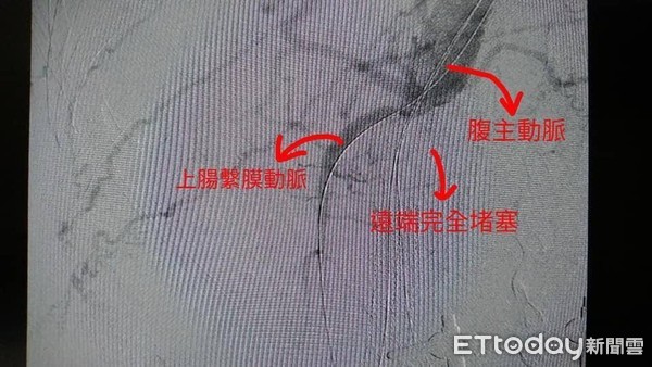 ▲▼透過電腦斷層發現，患者各動脈阻塞嚴重，若出現大範圍腸缺血壞死需要把全部腸子切除，嚴重可能死亡。（圖／門諾醫院提供，下同）