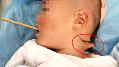 筷子刺入喉嚨「從後頸凸出來」！兩歲童叉著蘋果邊玩邊吃　阿嬤被X光片嚇哭
