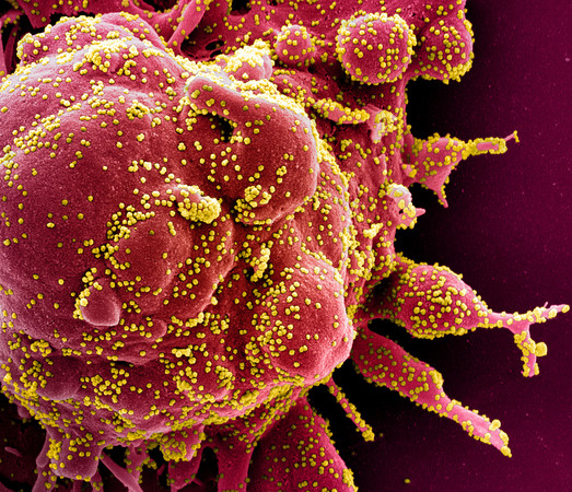▲▼電子顯微鏡下，遭新冠病毒感染致逐漸凋亡的人體細胞,COVID-19,新冠肺炎。（圖／路透）