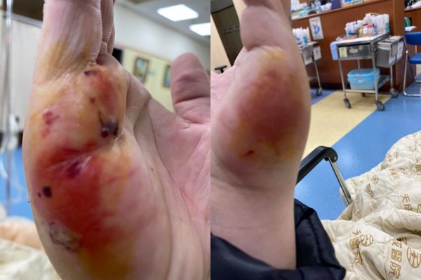 ▲外送員遭客人咬傷,客人也發文。(圖/翻攝自爆料公社二社,下同) ▲外送員遭客人咬傷,客人也發文。(圖/翻攝自爆料公社二社,下同)