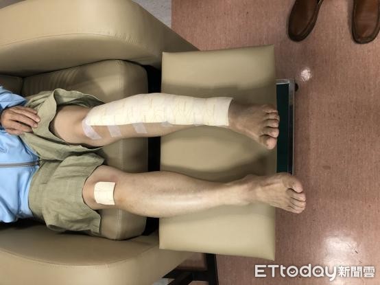 ▲竹山秀傳醫院推先進敷料,助傷口換藥免痛又能加速癒合。(圖/竹山秀傳醫院提供) ▲竹山秀傳醫院推先進敷料,助傷口換藥免痛又能加速癒合。(圖/竹山秀傳醫院提供)