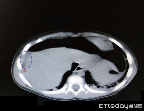 ▲經電腦斷層發現，女童腹腔內有不正常的游離空氣（如紅圈所示）及腹水（藍圈處），因此緊急安排手術處理。（記者黃孟珍攝）