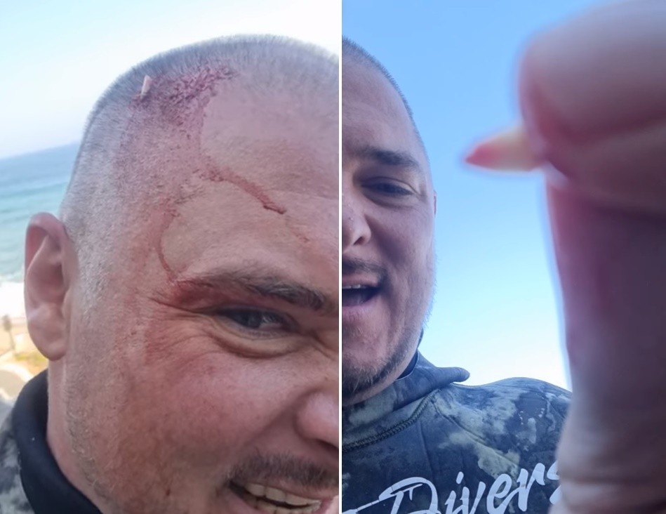 ▲▼ 南非38歲男子賈里德諾曼（Jarid Norman）日前被鯊魚襲擊，頭上卡著牠的牙齒。（圖／翻攝自臉書）