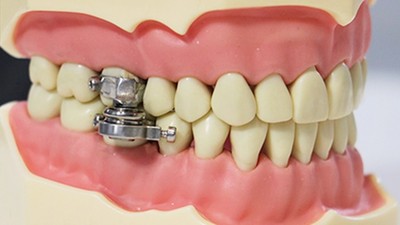 裝「磁鐵牙套」保證瘦！紐教授發明減肥神器　鎖緊上下排牙齒想吃好難