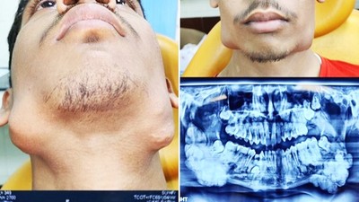密集！國字臉少年患罕病「5年內冒出82顆牙齒」驚駭X光照連醫生都看傻