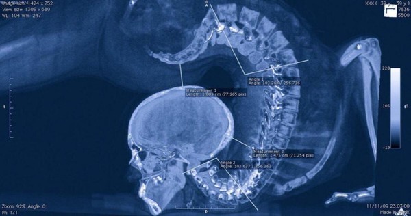 ▲▼美國論壇Reddit有網友表示，這是體操運動員在做體操時脊椎的X光片。（圖／翻攝自Reddit）