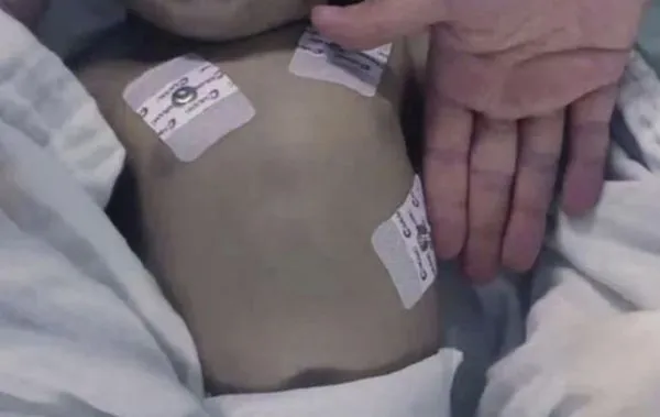 ▲▼兩新手媽聽說「奶粉上火」 「菜湯泡牛奶」害寶寶中毒命危變紫色。(圖/翻攝微博)