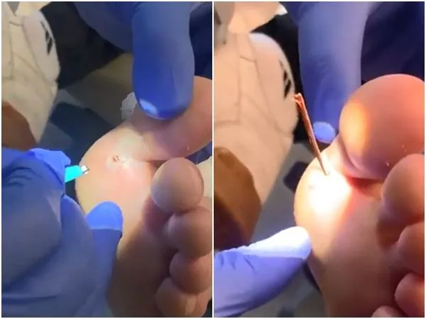 ▲▼男病患的腳底瞬間彈出「怪物級」超長木屑。(圖/翻攝自推特/@Perorationer)