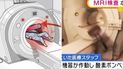做個檢查就沒命！MRI「高速吸附氧氣瓶」擊中60歲翁　警見屍搖頭：像被輾過