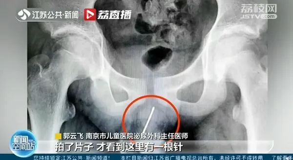 13歲男童血尿!檢查發現「9cm長針」插尿道 他尷尬:自己塞的。(圖/翻攝自微博/江蘇新聞)