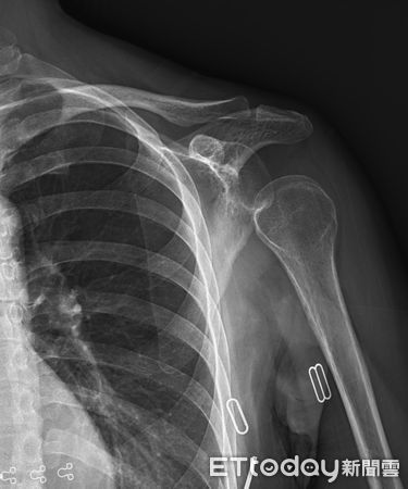 ▲中風患者肩部半脫位的X光影像。（圖／部立南投醫院提供）