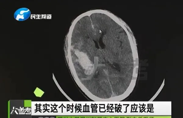 上廁所太用力!男上完頭痛2天 就醫發現「腦溢血」差點喪命。(圖/翻攝自YouTube/今日熱搜)