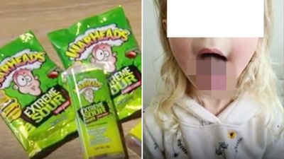 舌頭爛掉！女童偷吃一大把整人酸糖「舌頭燒出2公分大洞」醫驚：這糖很危險