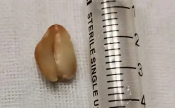 男咳嗽9年喘到不能呼吸 醫驚見支氣管「卡一顆花生」:發芽了。(圖/翻攝自微博/瀟湘晨報)