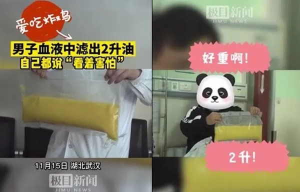 愛吃炸雞宵夜!137公斤男胃痛住院 血液抽出2公升「乳白油漿」。(圖/翻攝自微博/極目新聞)