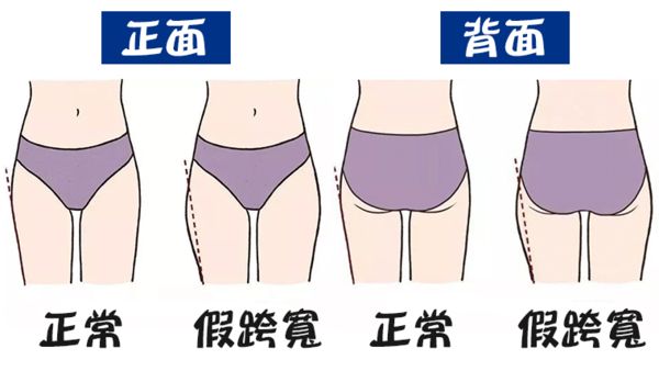 大腿蹦出兩塊肉 不一定是胖!一切都是「馬鞍肉」惹的禍(圖/業者提供)