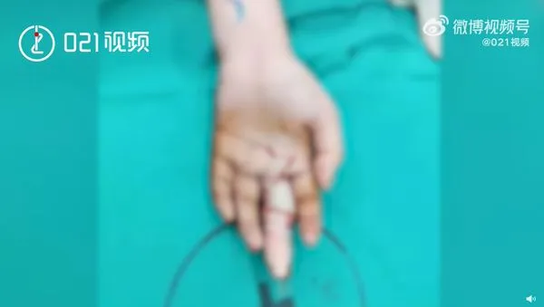 戒指卡住硬扯瞬間骨肉分離 「7公分手指變白骨」19歲女崩潰就醫。(圖/翻攝微博/021視頻)
