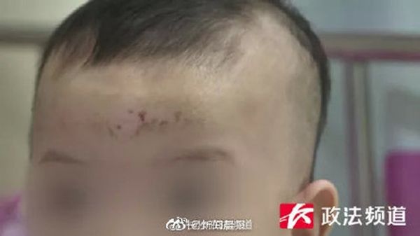 ▲婆婆用銀戒指刮痧,害女嬰額頭潰爛。(圖/翻攝自微博)