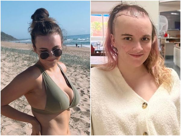 ▲▼澳洲21歲巨乳正妹巴妮特(Annie Barnett)腦中長了5顆動脈瘤,醫師削去她的部分顱骨,才救回她一命。(圖/翻攝自IG/annie.barnett)