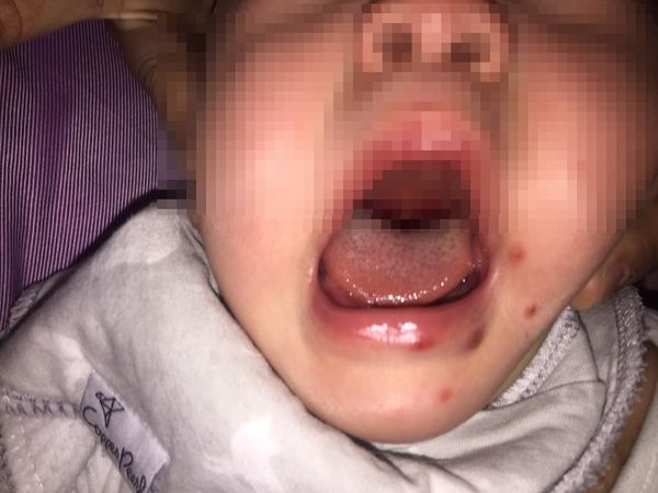 ▲▼1歲多雙胞胎口腔潰爛罹患「泡疹性齒齦舌炎」。（圖／施勝桓診所提供）