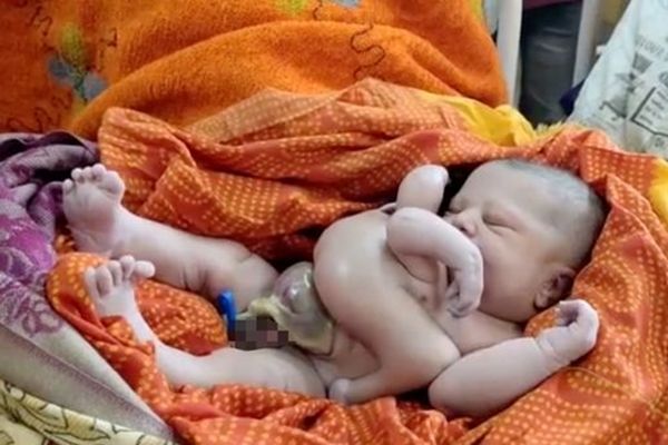 ▲▼ 印度孕婦生下4手4腳嬰兒。（圖／翻攝自Twitter）
