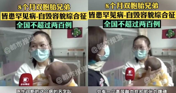 河南省兒童醫院有一對8個月大的雙胞胎男嬰，罹患上了會攻擊自己、自咬受傷的罕見疾病。（圖／翻攝自都市頻道）