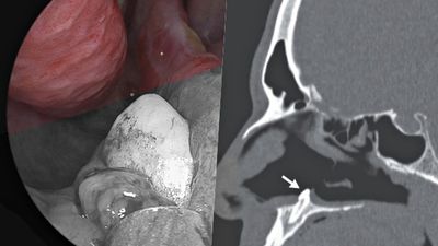 鼻孔長了一顆牙齒！美男單側鼻塞難受就醫　醫驚：這病症發生率僅0.1％