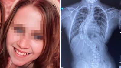 12歲女童背肩疼痛找不到原因　照X光發現「脊椎已80度大彎」
