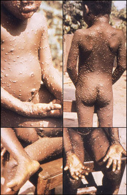 ▲▼感染猴痘出現的症狀，猴痘人傳人風險低。（圖／翻攝美國CDC網站）