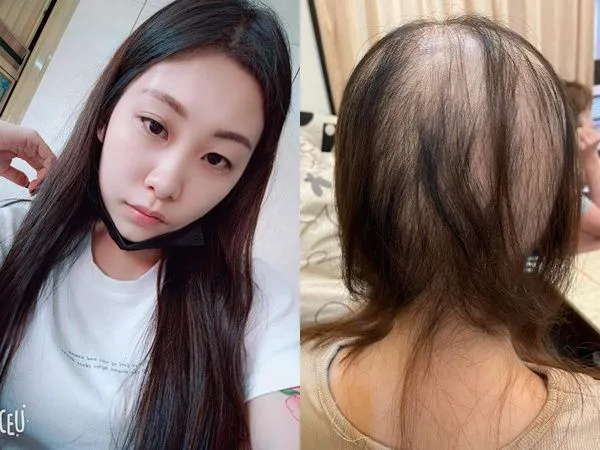 ▲▼長髮妹打1劑莫德納「6周掉光頭髮」 心痛照曝光:至少我還活著。(圖/翻攝爆料公社公開版)