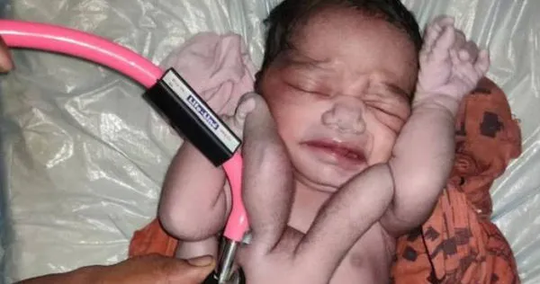 印度一名婦人生下有4手4腳的嬰兒。(圖/翻攝自@smallpawsdk推特,下同)