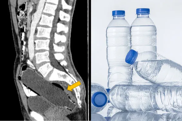 ▲▼已婚男腹痛不敢說 結果竟是寶特瓶卡肛門。(圖/Clinical Case Reports、CFP)