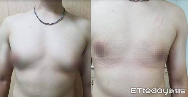 ▲胖男乳暈大、乳頭突被笑「奶哥」超自卑,切乳腺甩女乳症成型男。(圖/光田醫院提供)