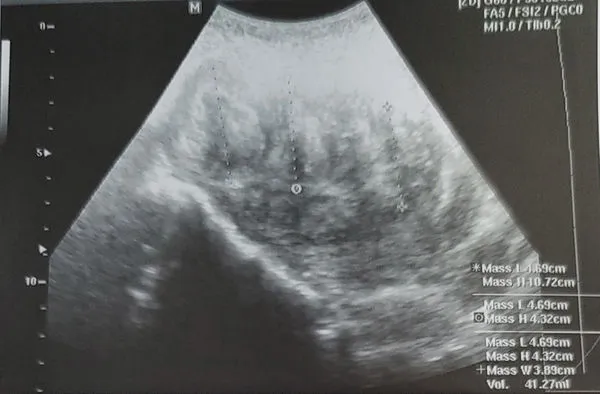 ▲▼宜蘭葉姓婦女超音檢查最大肌瘤在子宮宫底(上圖),另外3個肌瘤分別在子宮後壁和子宮頸後(圖/陽明交大附醫提供,下同)