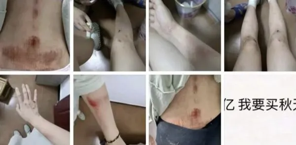 ▲女子在個人朋友圈中貼出渾身是傷的照片。(圖/翻攝微博)