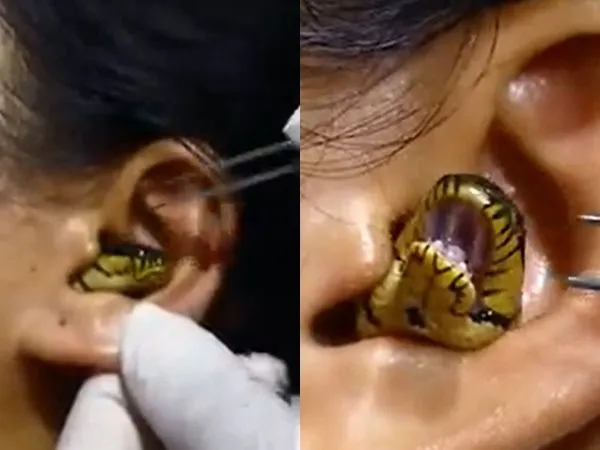 ▲▼黃蛇藏耳朵內「張嘴扭動」!醫師狂夾失敗 驚悚影片曝光。(圖/翻攝Chandan Singh臉書)