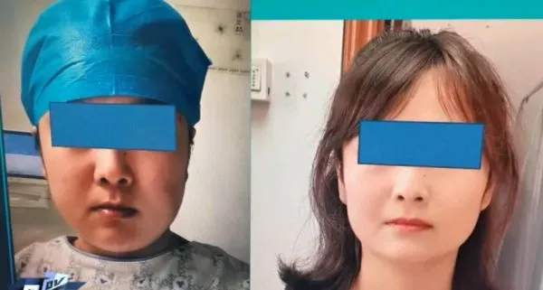 ▲▼熟女突爆肥「變月亮臉」 忍一年就醫發現「腦下垂體腫瘤」。(圖/翻攝微博)