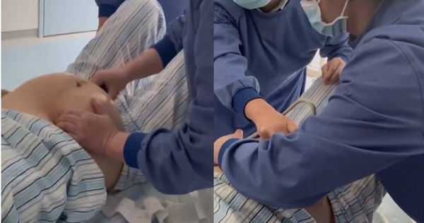 醫師隔著孕婦肚皮把胎位不正的寶寶喬回正確的位置。（圖／翻攝自微博）