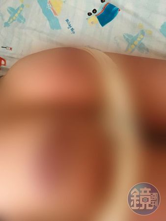 小傑(化名)被教練張兆祿連打了3天,臀部的瘀青與傷痕清晰可見。(讀者提供)