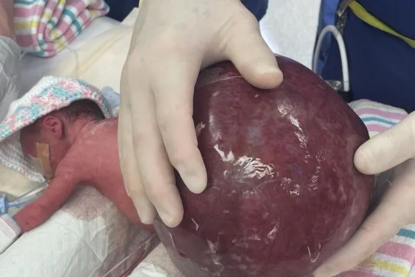 ▲▼澳洲女嬰賽樂(Saylor Thomson)尾椎長出重達2公斤的腫瘤。(圖/翻攝瑪特婦產科醫院)