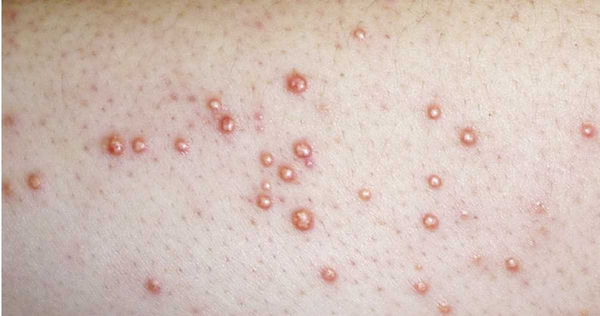 膽固醇嚴重超標時,會沉積在皮膚表面形成黃色瘤,過去比較常在老年人身上見到,如今竟有年輕學生患者,讓醫師相當驚訝。(圖/翻攝自林旻憲醫師部落格)