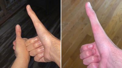 23歲男「大拇指是別人2倍」　「靠比讚」拍片TikTok吸260萬粉
