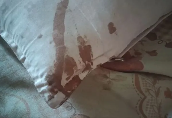 ▲▼半夜後頸劇痛!他一摸「枕頭全是血」見床邊1粒秒衝醫院。(圖/翻攝自微博)