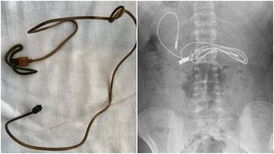 土耳其男孩「充電線卡胃裡」　手術拉出醫見長度驚嘆：當下有點艱難