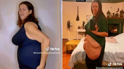 5年減重167公斤「卻消不掉肚皮」　她手術切除後樂喊：終於看得見膝蓋