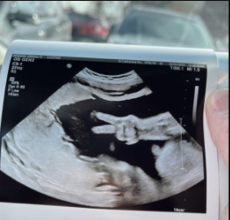 ▲▼媽媽在產檢時意外拍下胎兒比YA的超音波照。（圖／翻攝自Facebook／Kyle Weener）