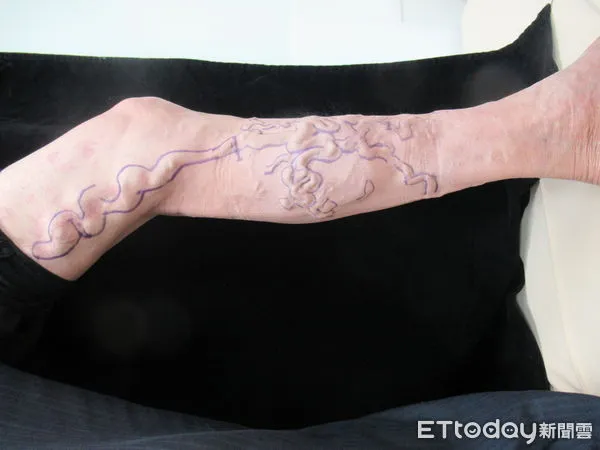 ▲陳姓患者靜脈曲張情形。(圖/衛福部南投醫院提供)